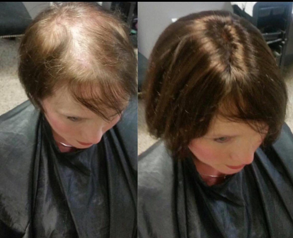 Trichotillomania Hair Regrowth Expert Tips and Strategies Boston, Mas noellesalon
